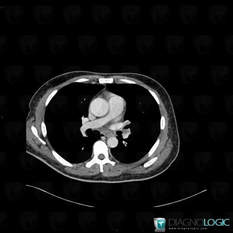 Tuberculosis, Mediastinum, CT