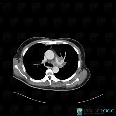 Tuberculosis, Mediastinum, CT