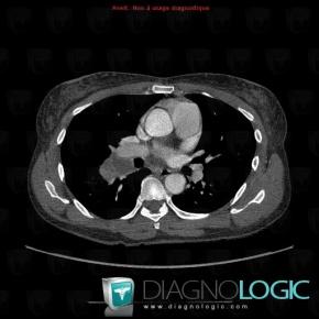 Tuberculosis, Mediastinum, CT
