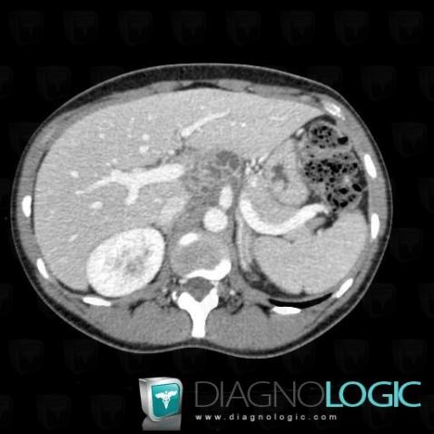 Tuberculosis, Mesentery / Peritoneum, CT