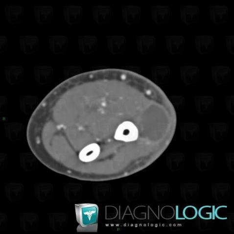 Tuberculosis, Other soft tissues/nerves - Arm, CT