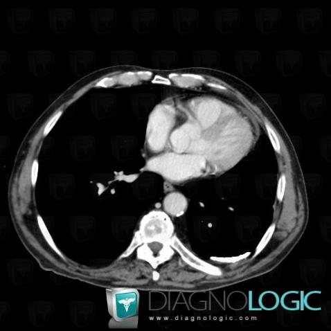 Tuberculosis, Pleura, CT