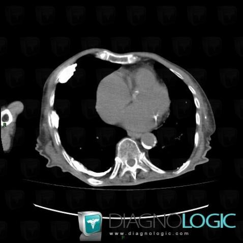 Tuberculosis, Pleura, CT