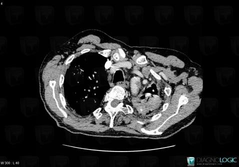 Tuberculosis, Pulmonary artery, CT