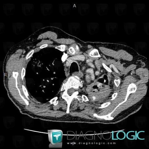 Tuberculosis, Pulmonary artery, CT