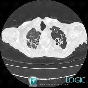 Tuberculosis, Pulmonary parenchyma, Airways, CT