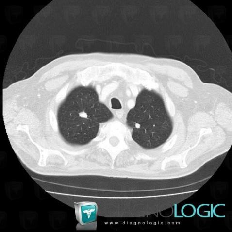 Tuberculosis, Pulmonary parenchyma, CT