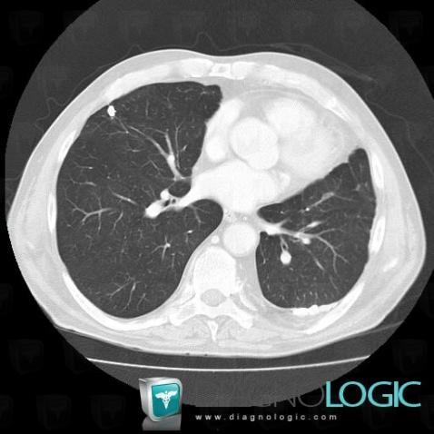 Tuberculosis, Pulmonary parenchyma, CT