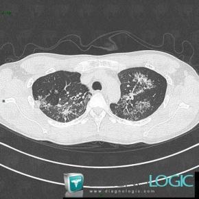 Tuberculosis, Pulmonary parenchyma, CT