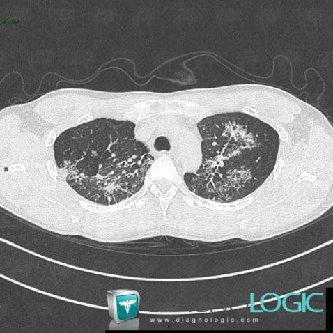 Tuberculosis, Pulmonary parenchyma, CT