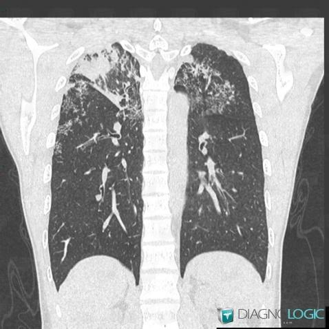 Tuberculosis, Pulmonary parenchyma, CT