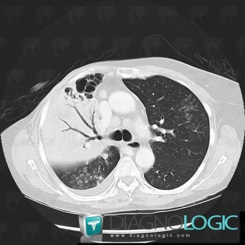 Tuberculosis, Pulmonary parenchyma, CT