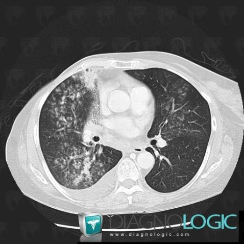 Tuberculosis, Pulmonary parenchyma, CT