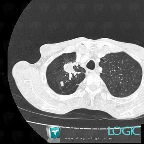 Tuberculosis, Pulmonary parenchyma, CT