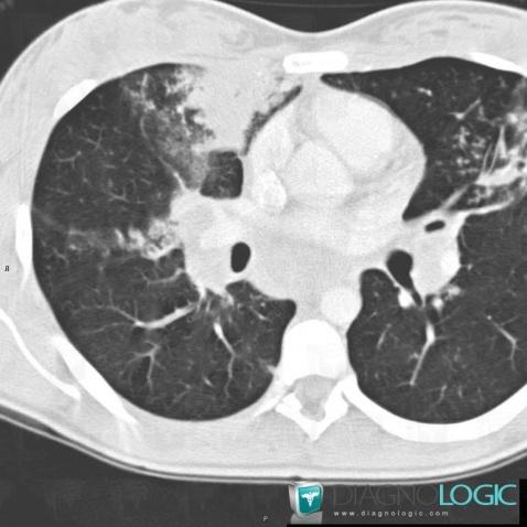 Tuberculosis, Pulmonary parenchyma, CT