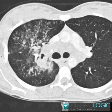 Tuberculosis, Pulmonary parenchyma, CT