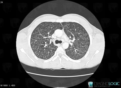 Tuberculosis, Pulmonary parenchyma, CT