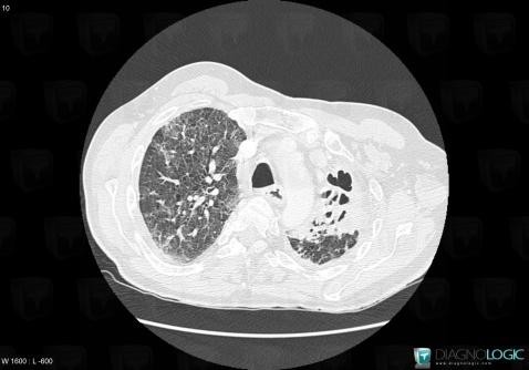 Tuberculosis, Pulmonary parenchyma, CT