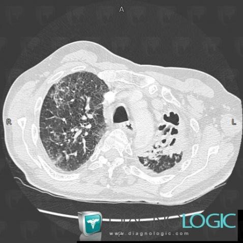 Tuberculosis, Pulmonary parenchyma, CT