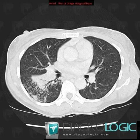 Tuberculosis, Pulmonary parenchyma, CT