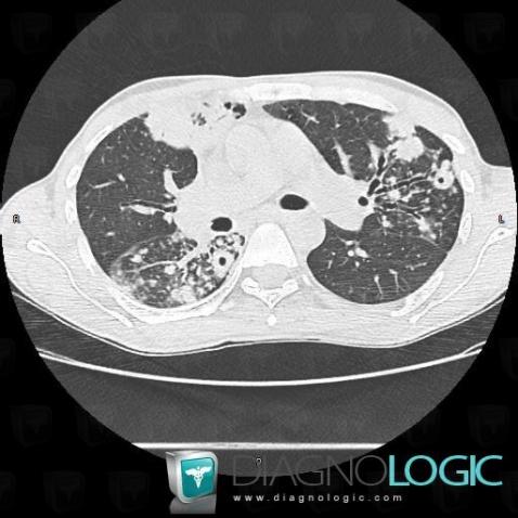 Tuberculosis, Pulmonary parenchyma, CT