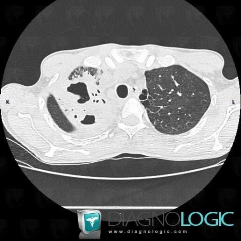 Tuberculosis, Pulmonary parenchyma, CT