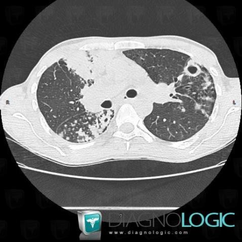 Tuberculosis, Pulmonary parenchyma, CT