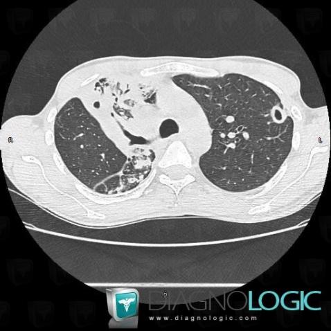 Tuberculosis, Pulmonary parenchyma, CT