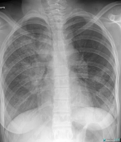 Tuberculosis, Pulmonary parenchyma, Hila, X rays