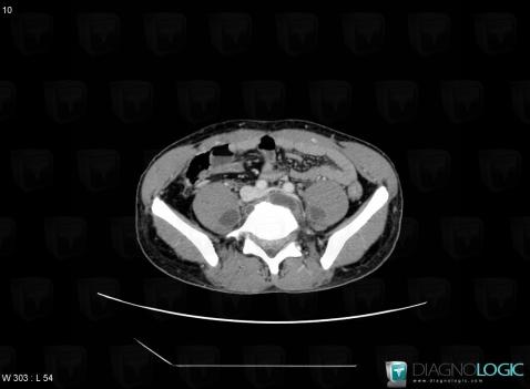 Tuberculosis, Retroperitoneum, CT