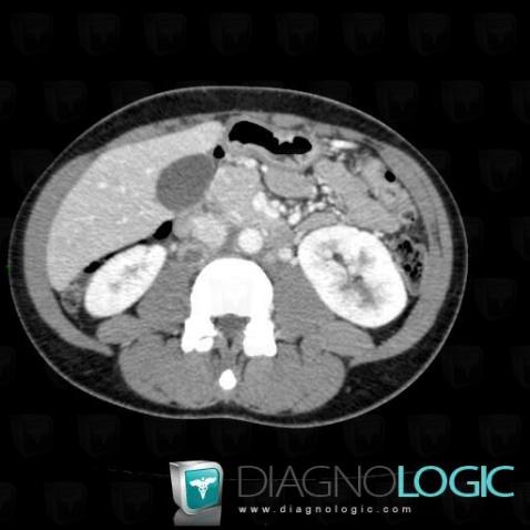 Tuberculosis, Retroperitoneum, CT