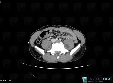 Tuberculosis, Retroperitoneum, Vertebral body / Disk, CT