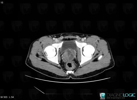 Tuberculosis, Seminal vesicles, CT