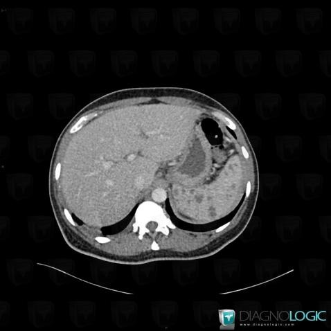 Tuberculosis, Spleen, CT