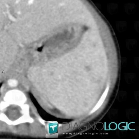 Tuberculosis, Spleen, CT