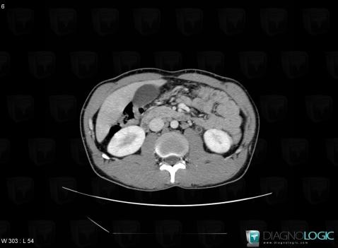 Tuberculosis, Ureter, CT