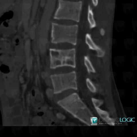 Tuberculosis, Vertebral body / Disk, Theoretical