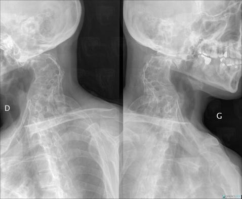 Tuberculosis, Vertebral body / Disk, X rays