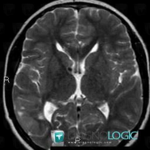 Tuberous sclerosis, Basal ganglia and capsule, MRI