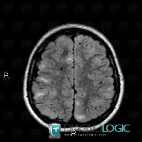 Tuberous sclerosis, Cerebral hemispheres, MRI