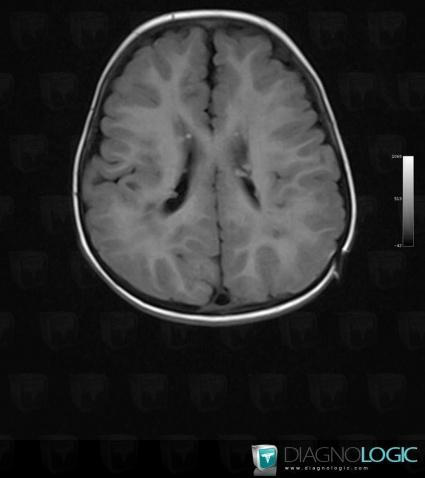 Tuberous sclerosis, Cerebral hemispheres, Ventricles / Periventricular region, MRI