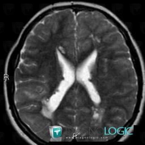 Tuberous sclerosis, Corpus callosum, MRI