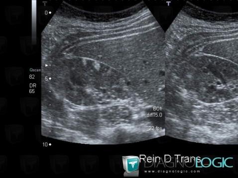 Tuberous sclerosis, Kidney, US