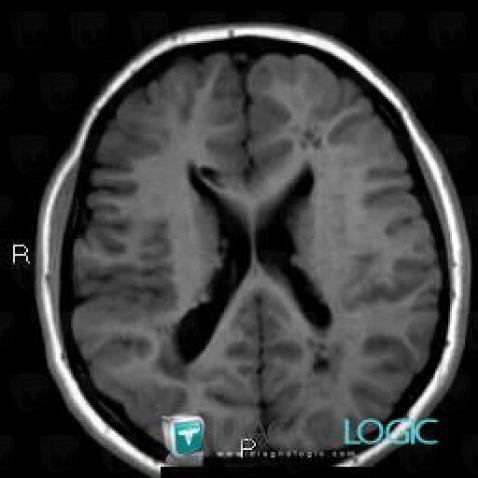 Tuberous sclerosis, Ventricles / Periventricular region, MRI