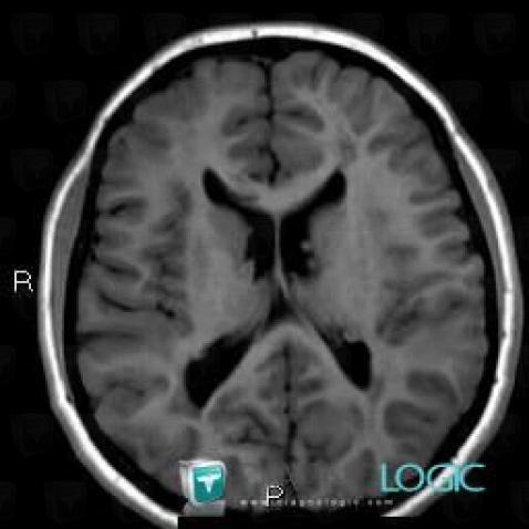 Tuberous sclerosis, Ventricles / Periventricular region, MRI