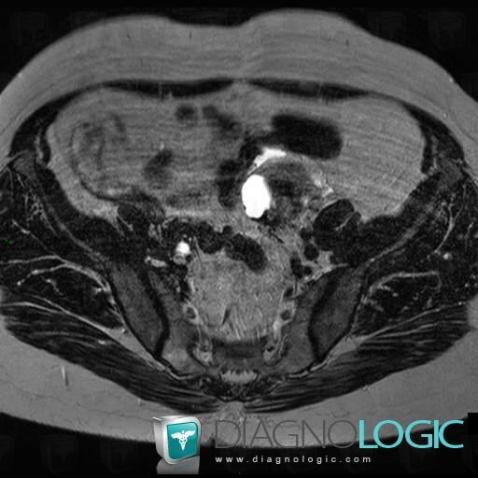 Tubo-ovarian abscess, Adnexa / Ovary fallopian tube, MRI