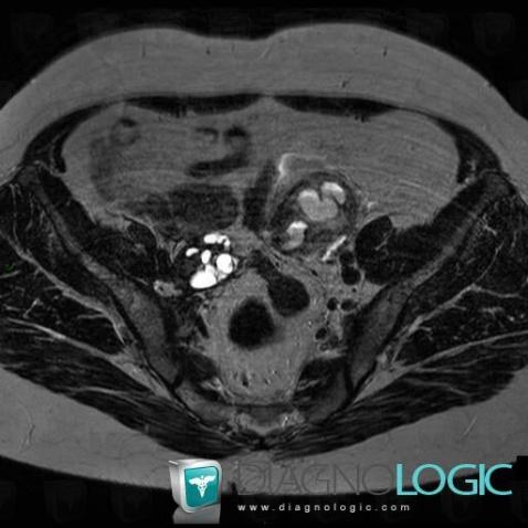 Tubo-ovarian abscess, Adnexa / Ovary fallopian tube, MRI