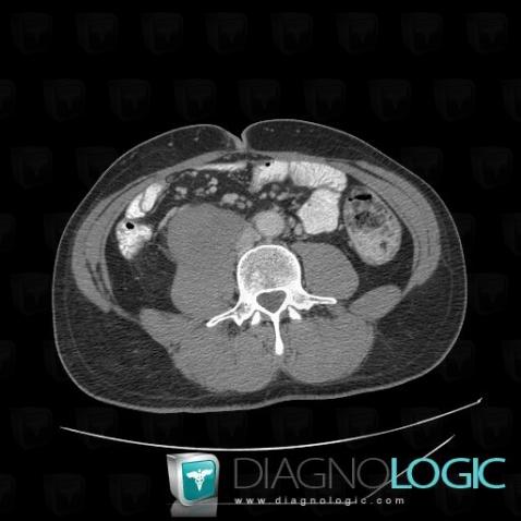 Cas radiologie : Tumeur desmoïde (Scanner) - Diagnologic