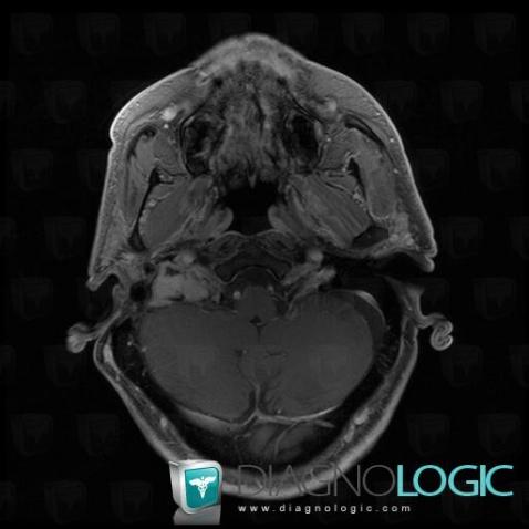 Tumeur-glomus jugulaire, Foramen jugulaire, IRM