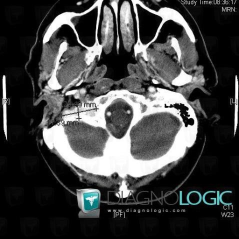 Tumeur-glomus jugulaire, Foramen jugulaire, Scanner